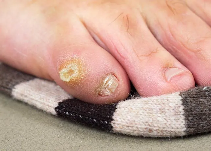 Corn on toe