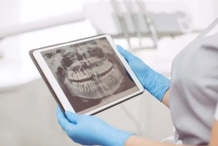 Smile Brighter with Digital X-Rays: A Leap Forward in Dental Care!