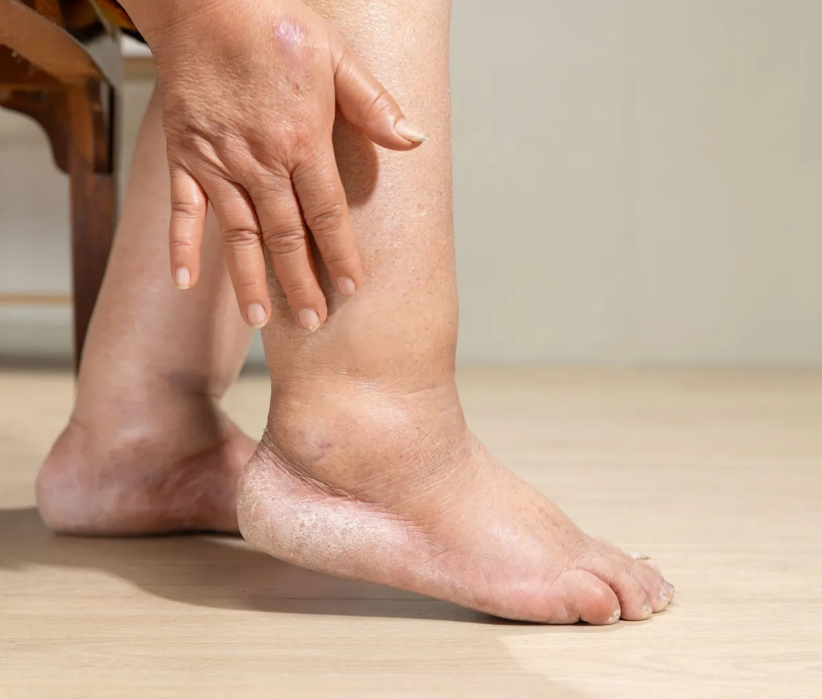 Why Are My Legs Swollen? A Deep Dive Into Causes and Relief