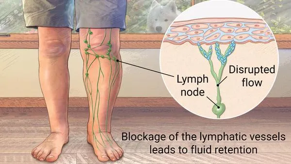 Complete Lymphedema Guide: Treatment Options That Work
