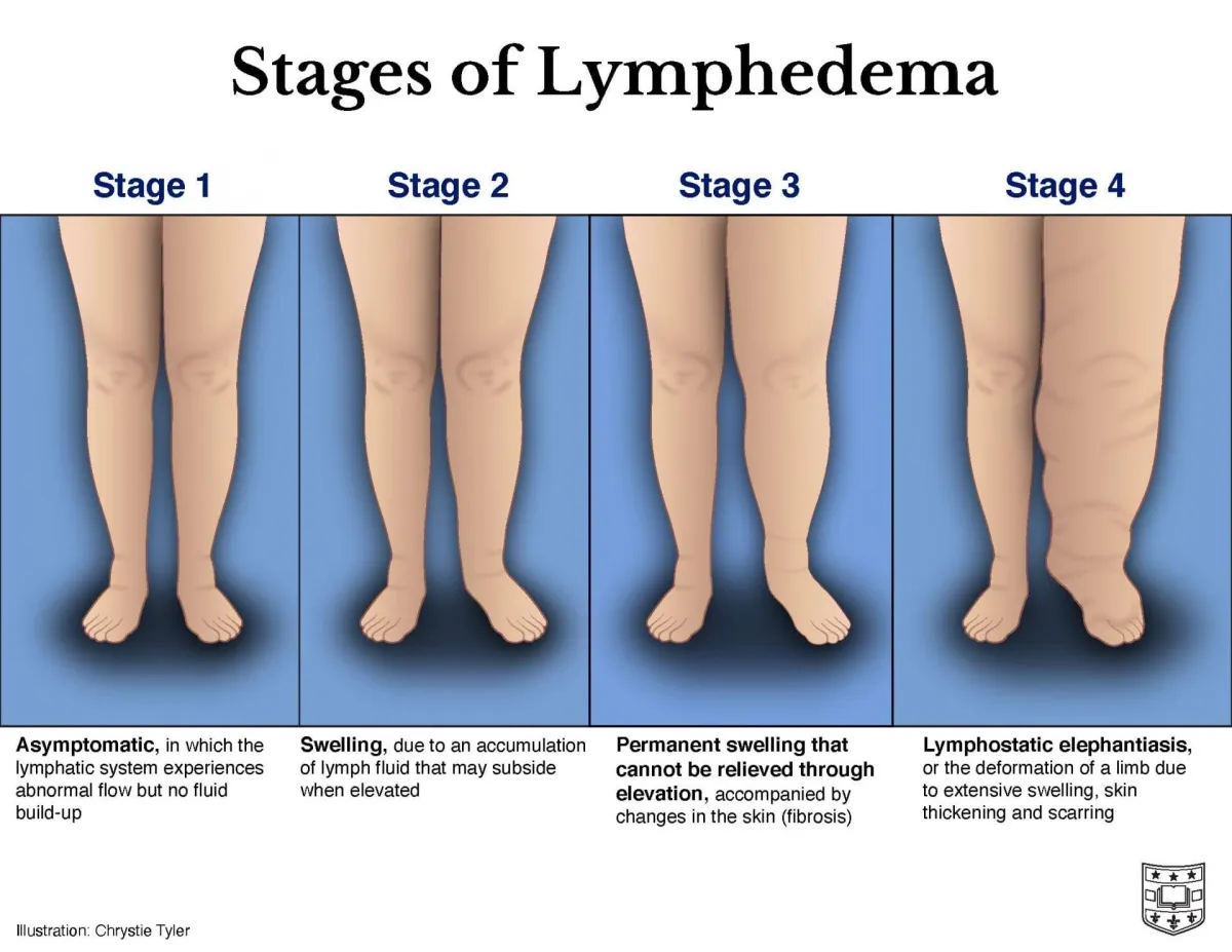 Why Are My Legs Swollen? Causes of Swelling and How to Get Relief