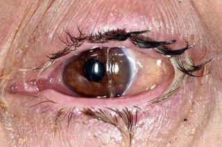 Conjunctivitis