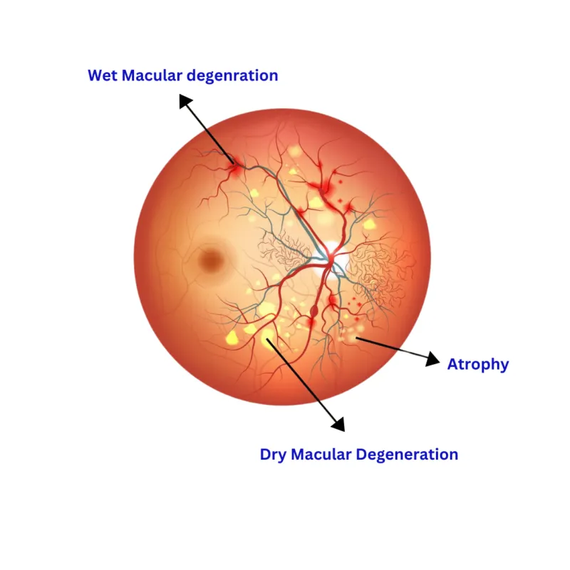 Age-Related Macular Degeneration
