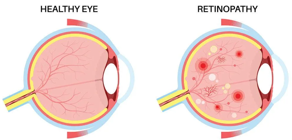 Retinopathy