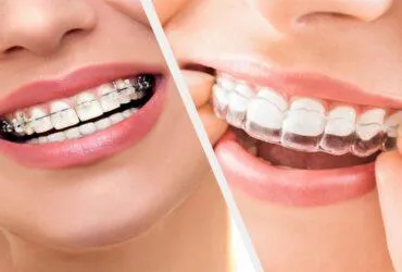 Side-by-side comparison of traditional braces and Invisalign aligners for orthodontic treatment.
