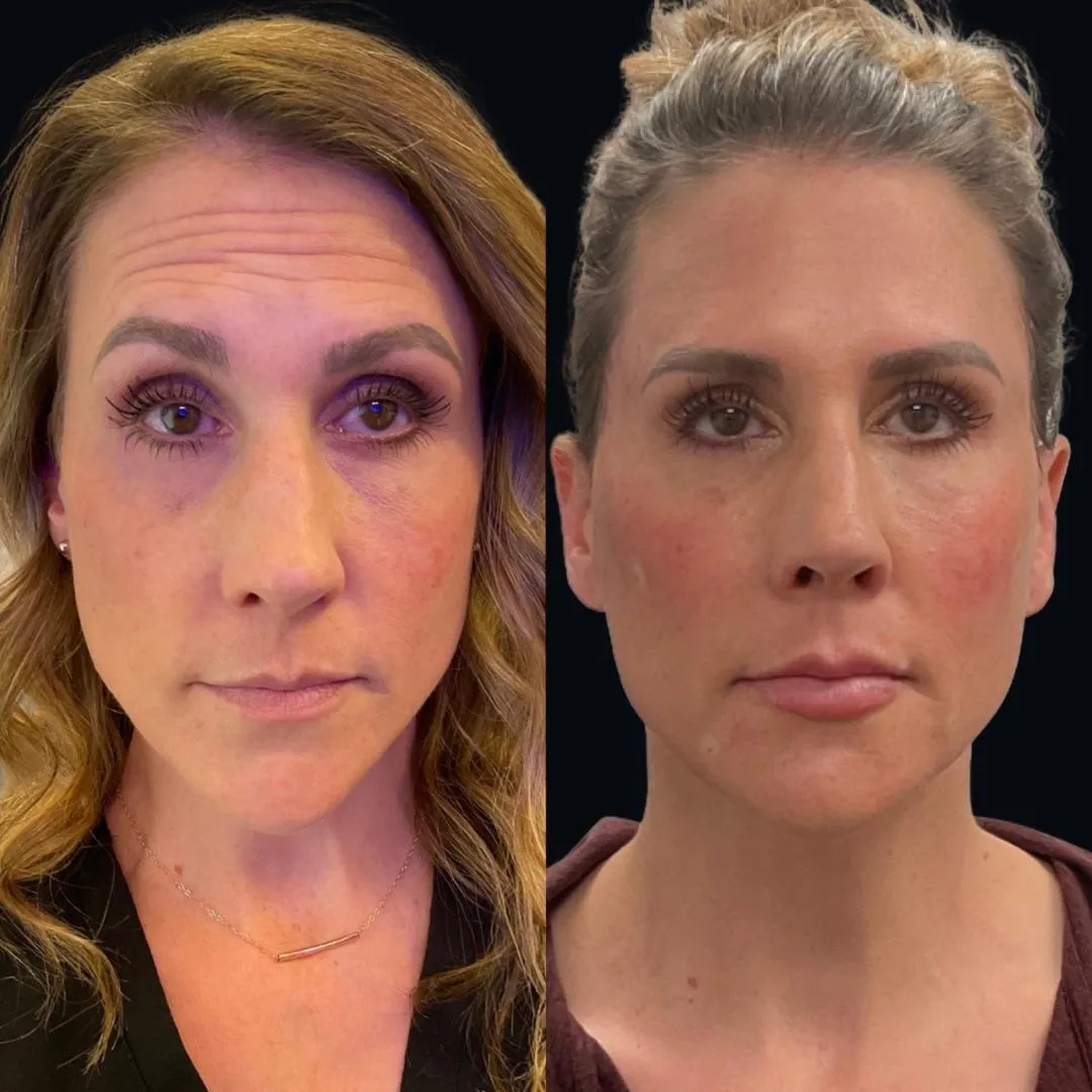 How To Restore Facial Balance and Youthfulness Without Surgery