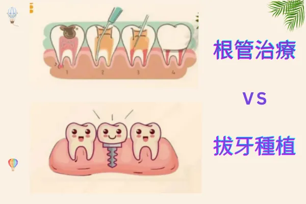 根管治療VS種植牙