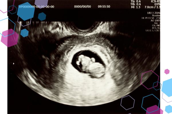 First trimester ultrasound — why early antenatal education matters, as explored in CubCare’s First Trimester course.
