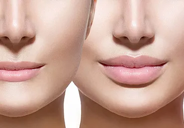 Lip Filler
