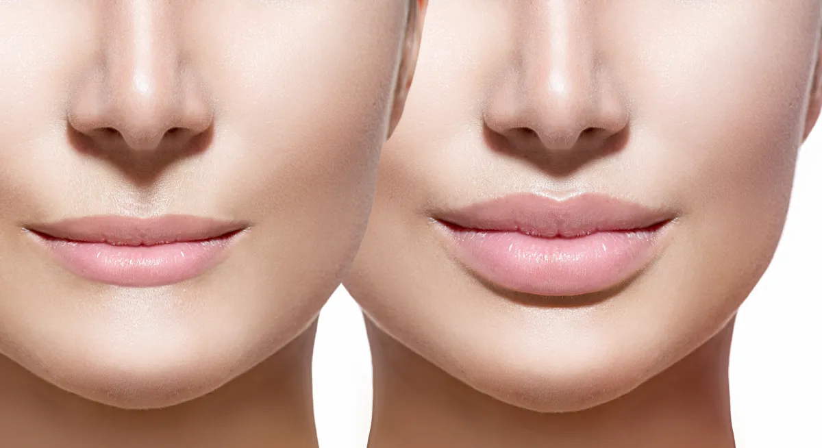 Lip Filler 