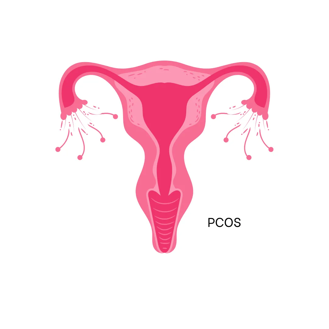 PCOS
