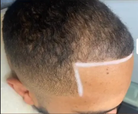 Hair Density Fill with SMP