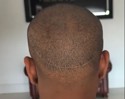 Fixing Hair Transplant Scars with SMP