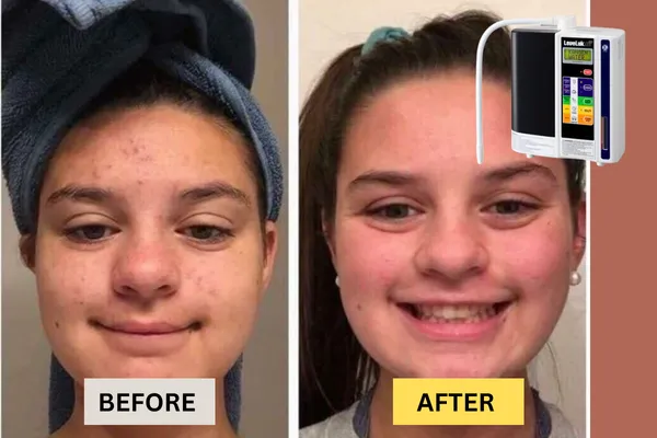 Acne with Kangen Water