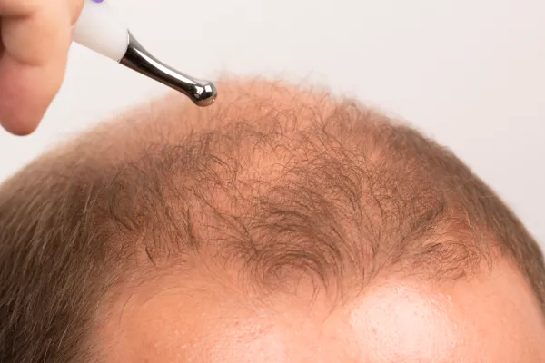 Finasteride for hair loss