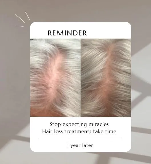 Hair Loss - Reality Check