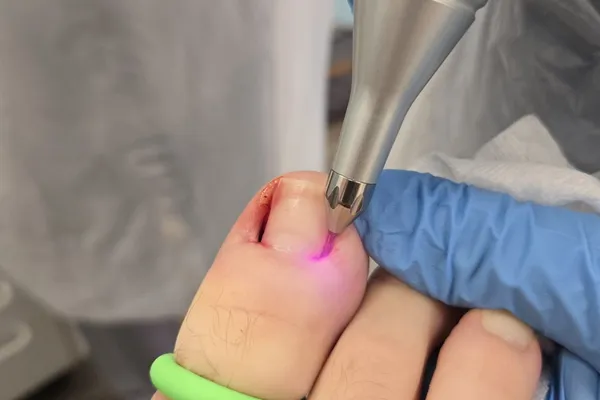 How Does K‑Laser Nail Surgery Compare to Phenol, and Which Heals Faster?