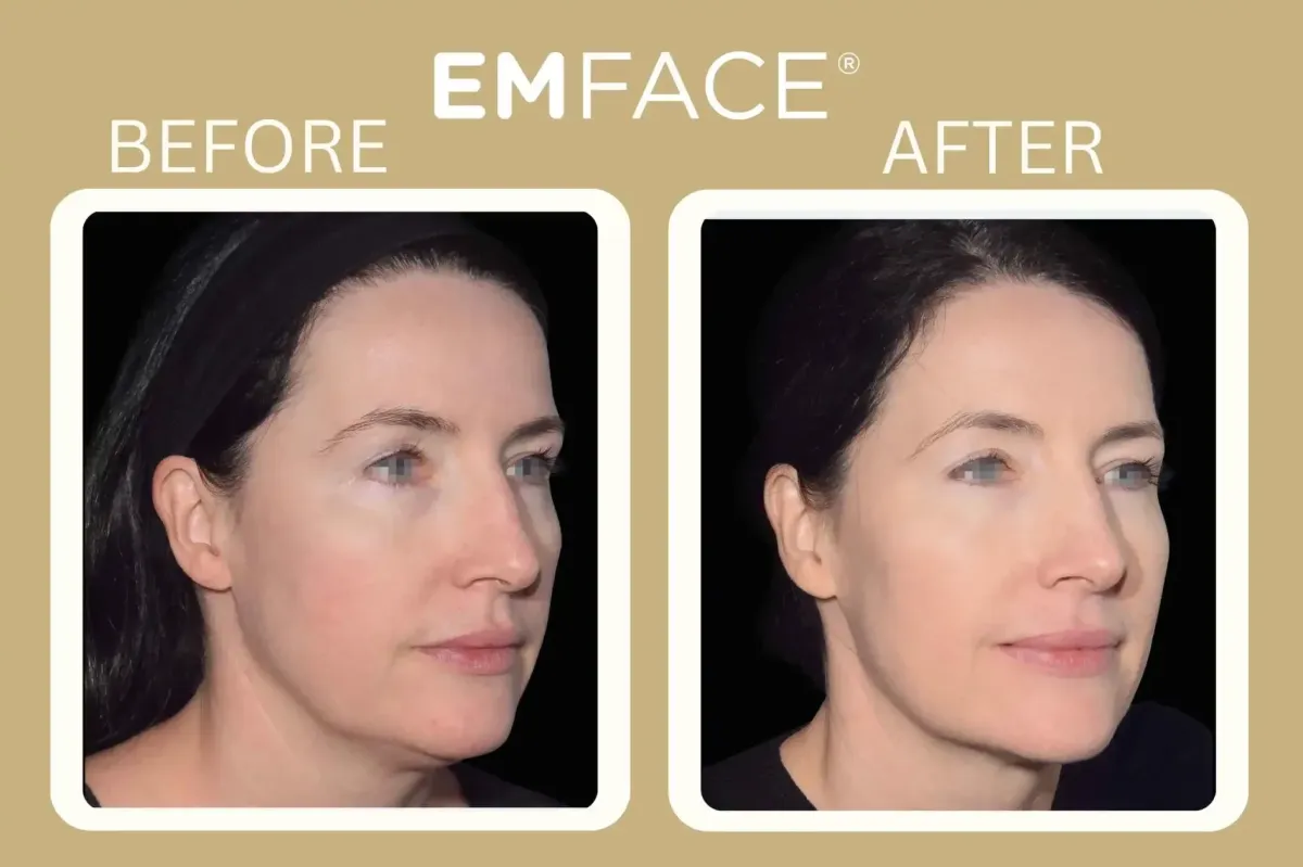 Emface Before and After Pictures | Real Emface Results