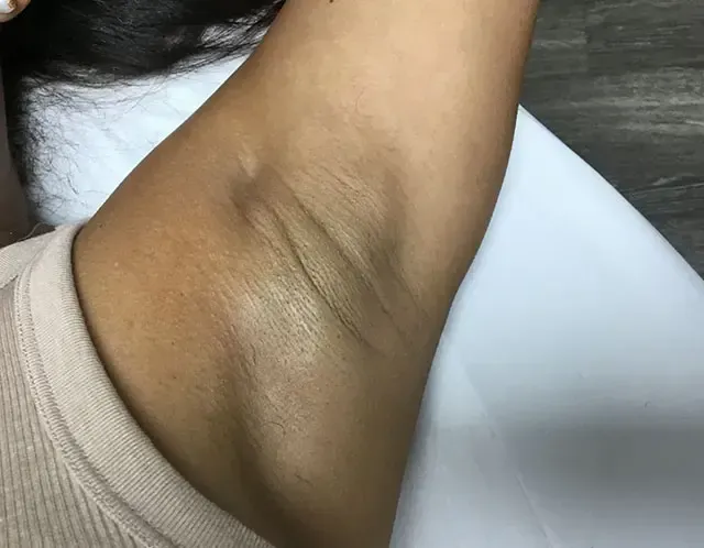 Tips for Laser Hair Removal On Dark Underarm