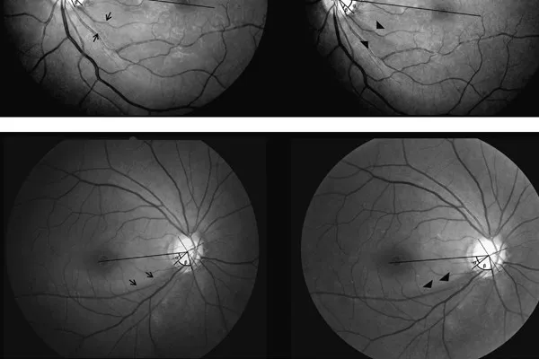 Retinal Nerve Fiber