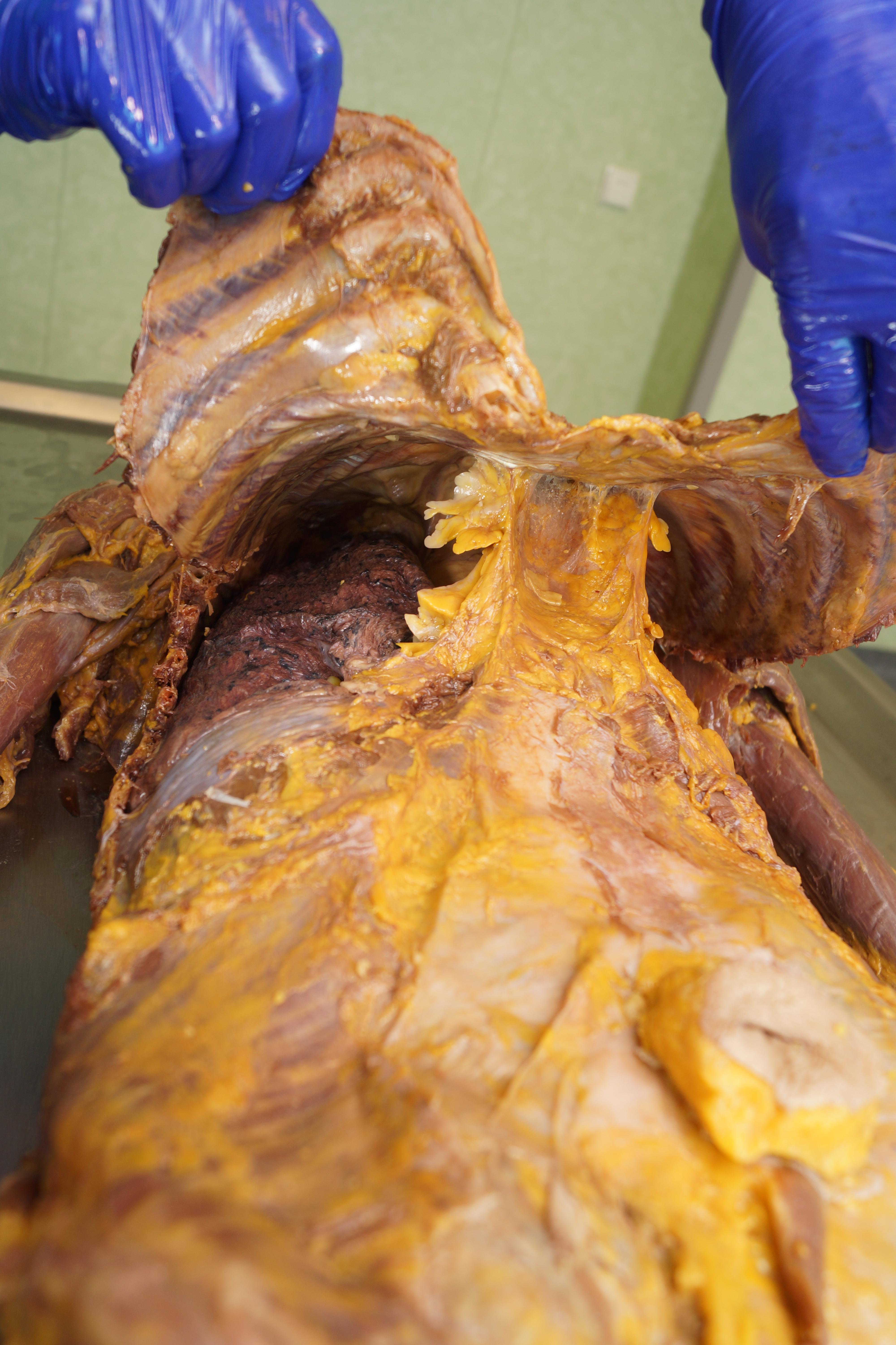 Dissection of abdomen and mediastinum showing greater omentum