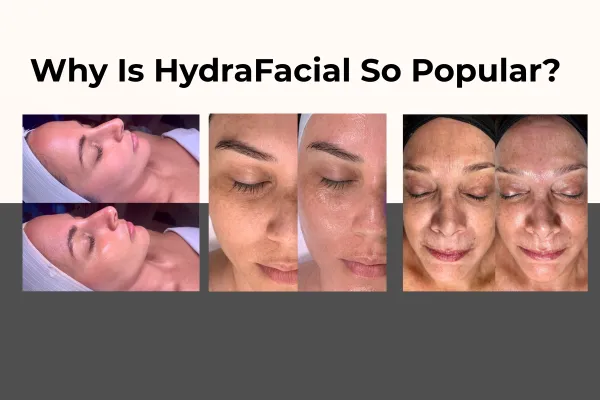 Close-up of smooth, glowing skin after HydraFacial treatment showcasing the instant radiance and hydration results of this popular facial procedure