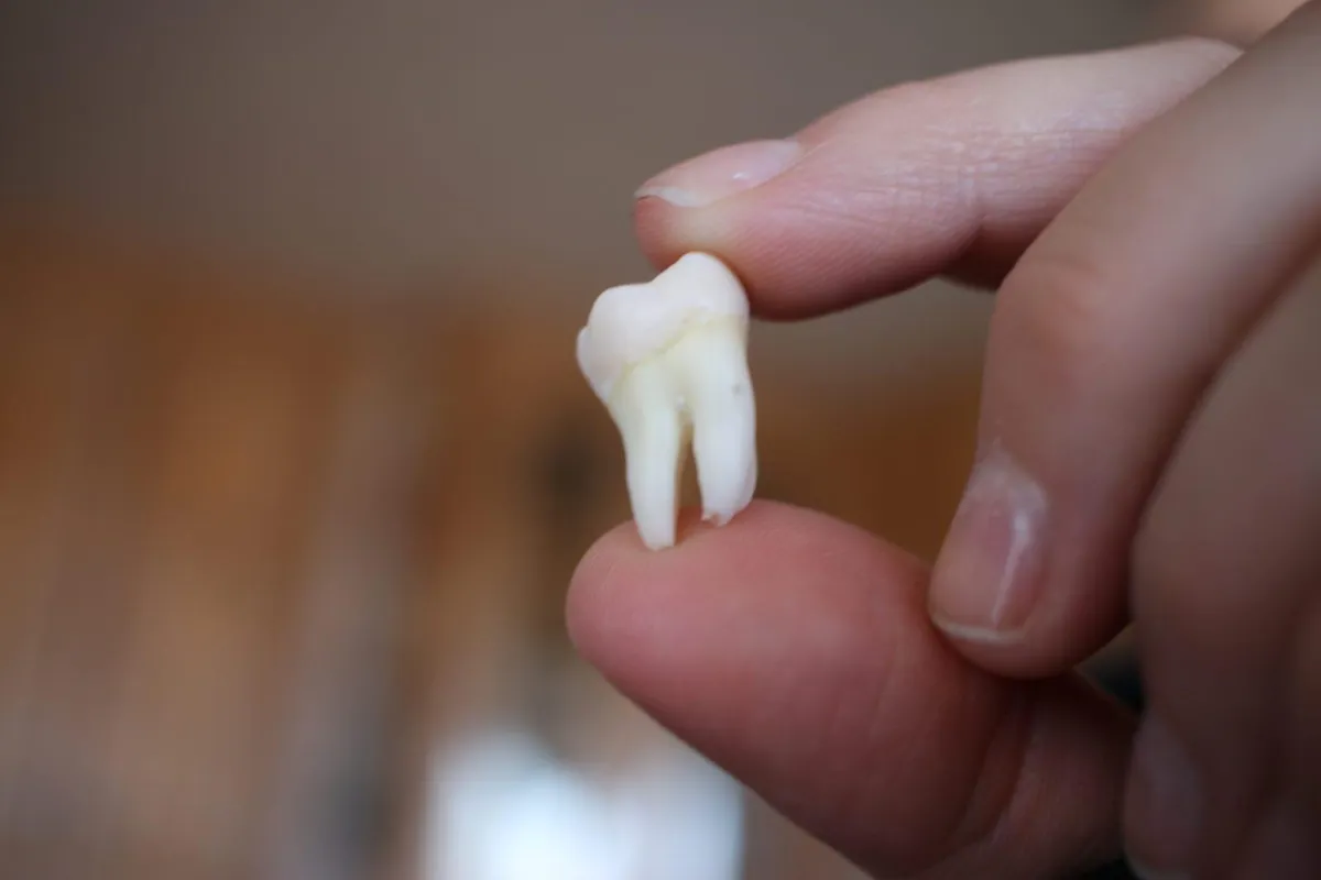 How To Know If Wisdom Teeth Should Be Removed | Joby Hurst, DMD