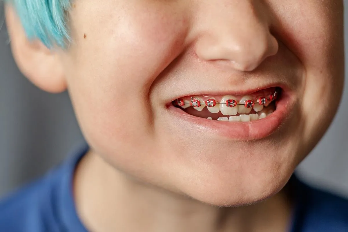 A Child with Teeth Bracing Problem