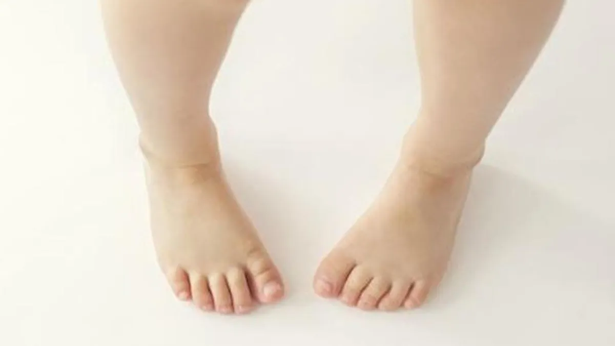 Intoeing In Children