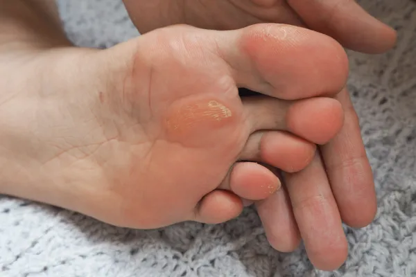 painful corns on foot