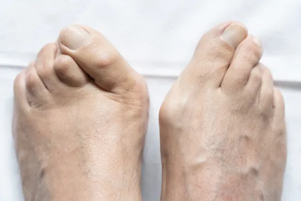 hammer toes