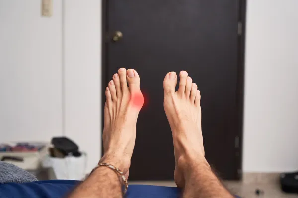 feet with bunions
