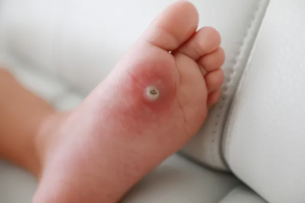 foot warts
