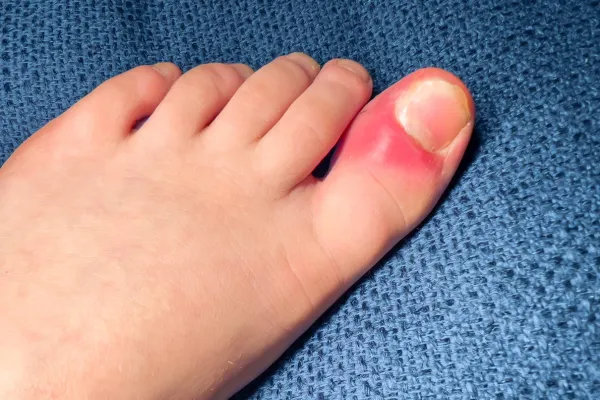 ingrown toenails