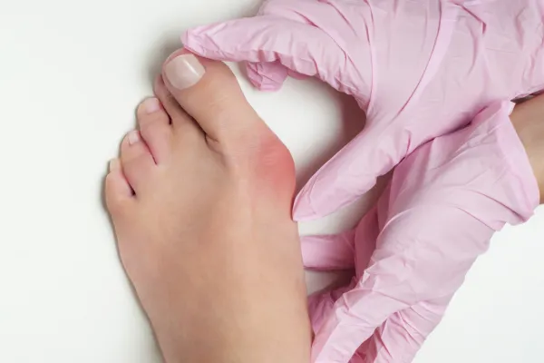 Can Bunions Get Worse If I Ignore Them?