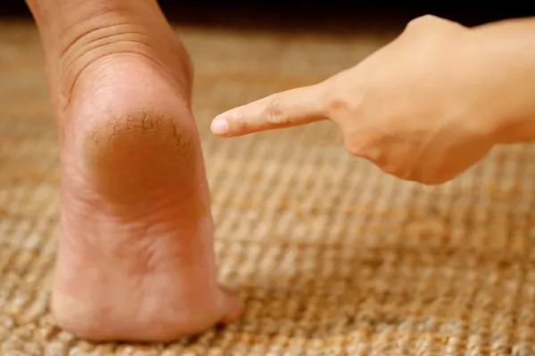 Is Cracked Heel Skin Just a Cosmetic Issue?