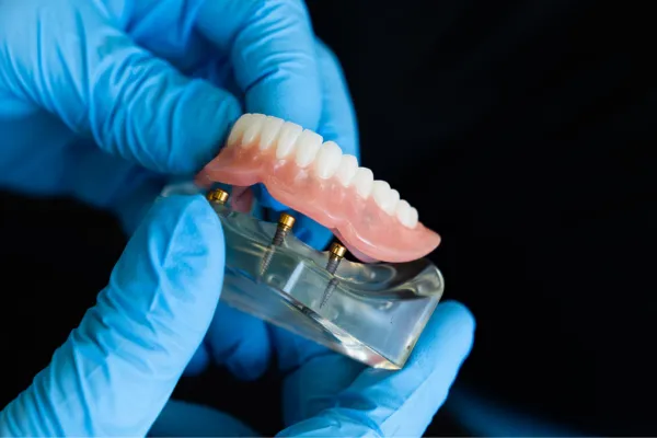 All-On-X Implant Denture