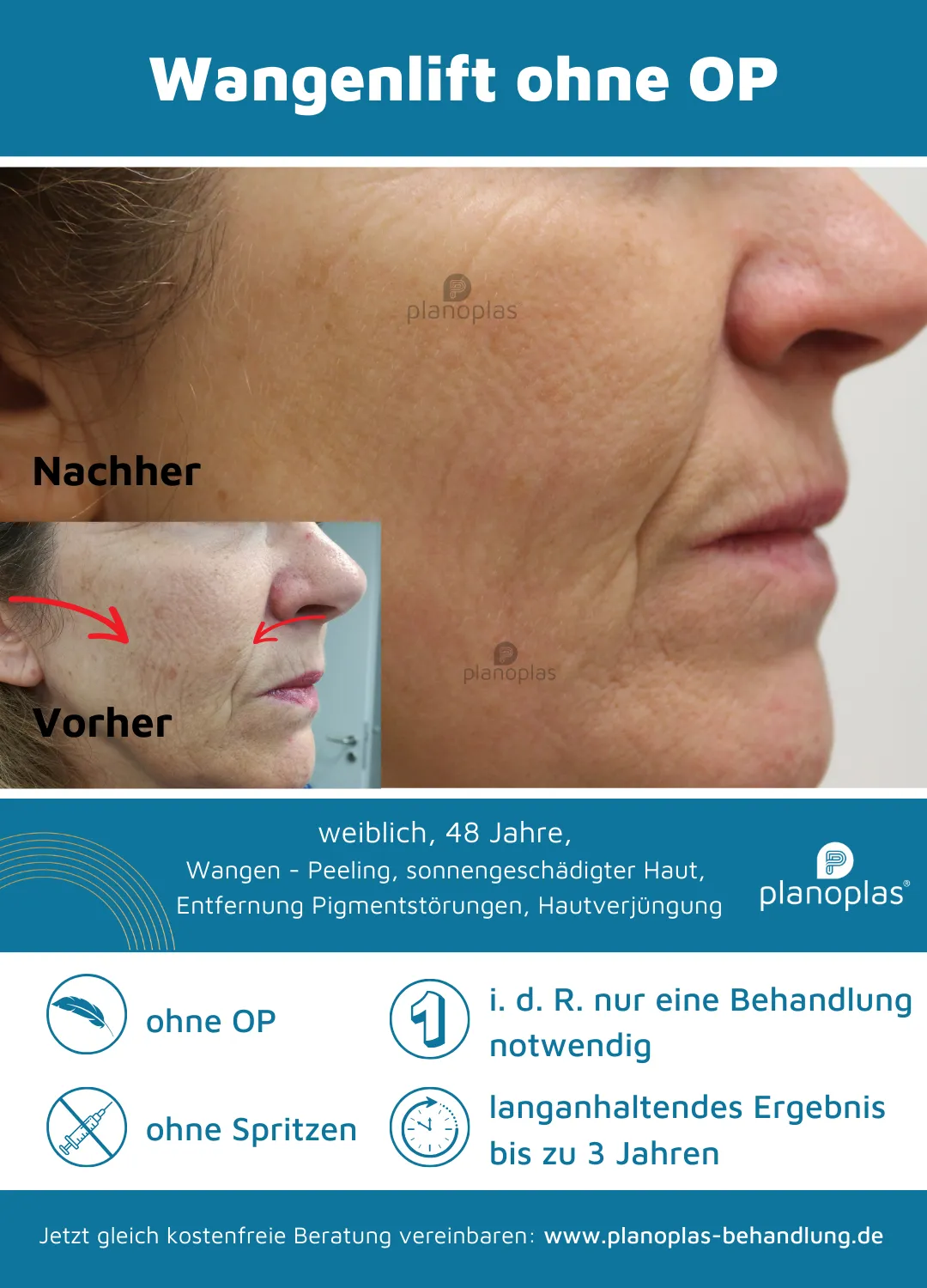 Vorher-Nachher-Bilder Wangenstraffung/Hautbildverfeinerung ohne OP mit dem planoplas® Plasma Pen