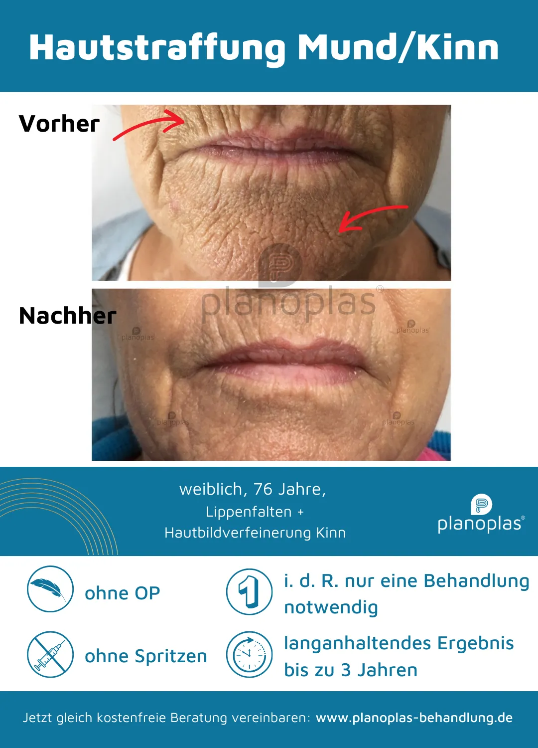 Vorher-Nachher-Bilder Mund und Kinnbereich ohne OP mit dem planoplas® Plasma Pen