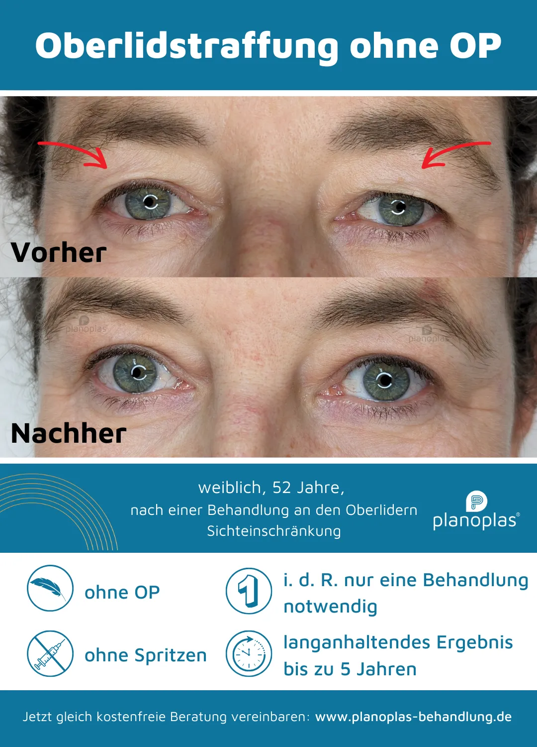 Vorher-Nachher-Bilder Lidstraffung ohne OP mit dem planoplas® Plasma Pen