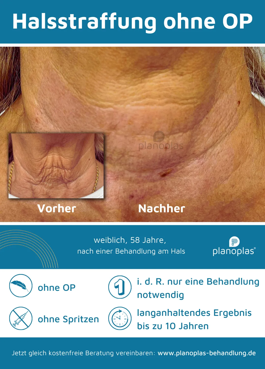 Vorher-Nachher-Bilder Halsstraffung ohne OP mit dem planoplas® Plasma Pen