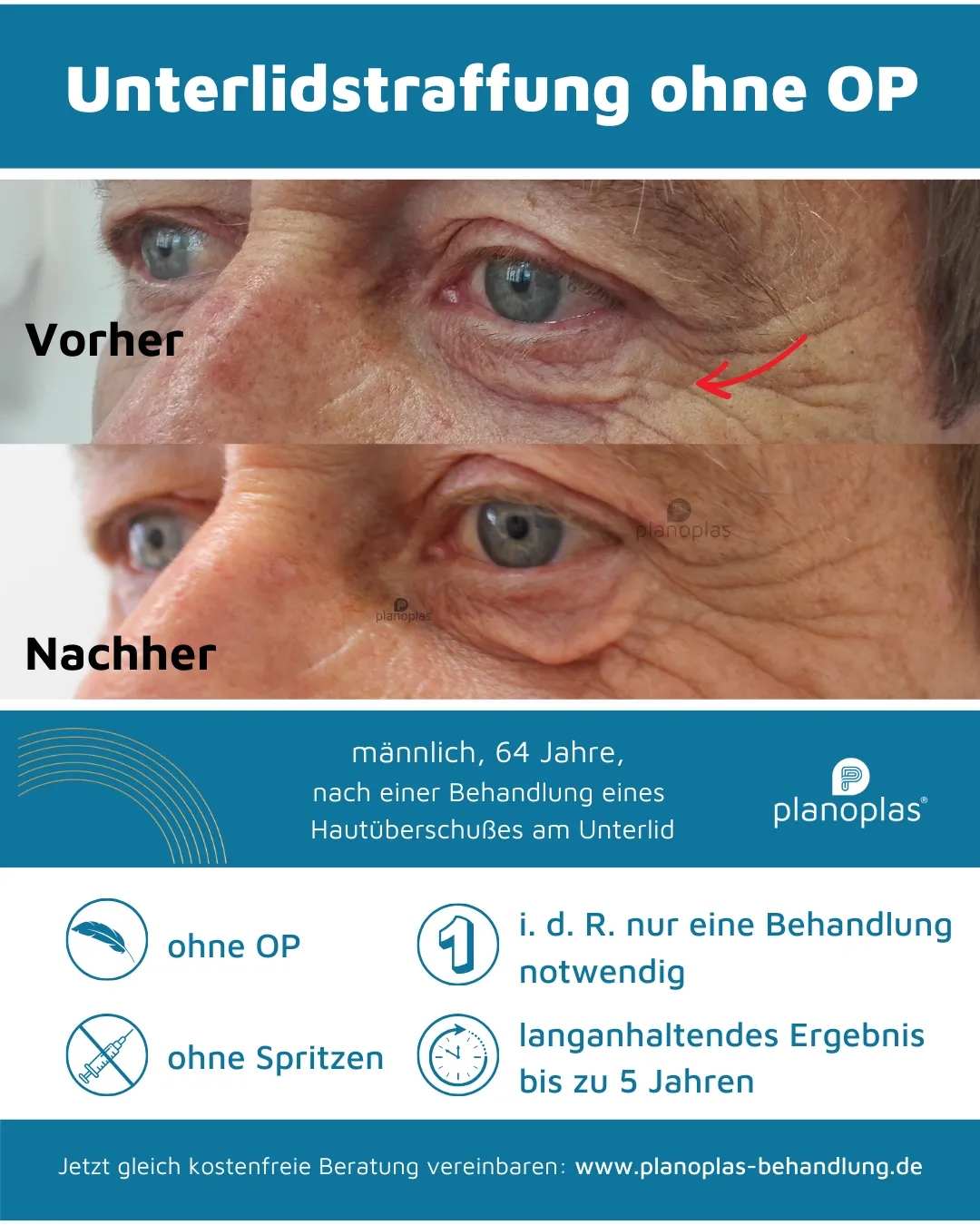 Vorher-Nachher-Bilder Unterlidstraffung ohne OP mit dem planoplas® Plasma Pen