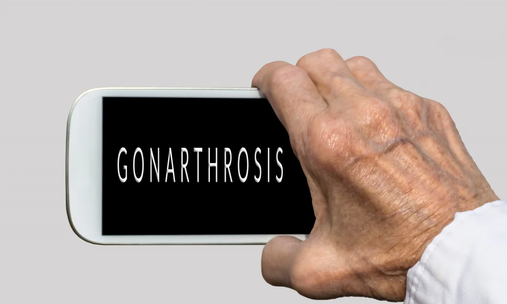 Bioresonance as an Alternative Treatment for Gonarthrosis