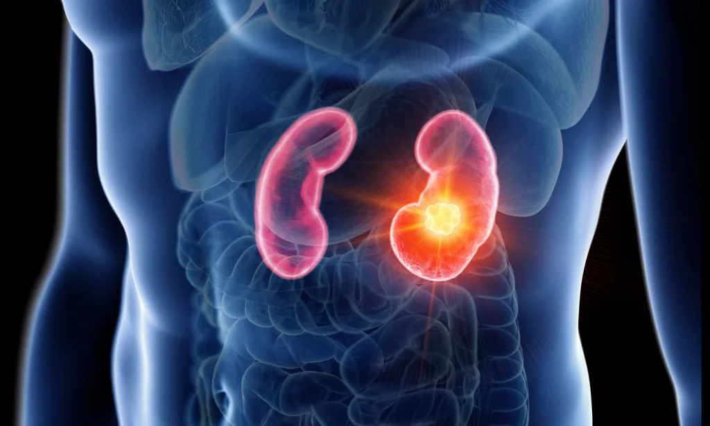 The Use of Bioresonance Therapy in the Fight Against Chronic Kidney Disease