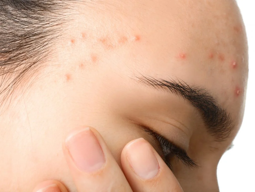 Hydrogen Water - The Very Latest New Technology for Acne Treatment