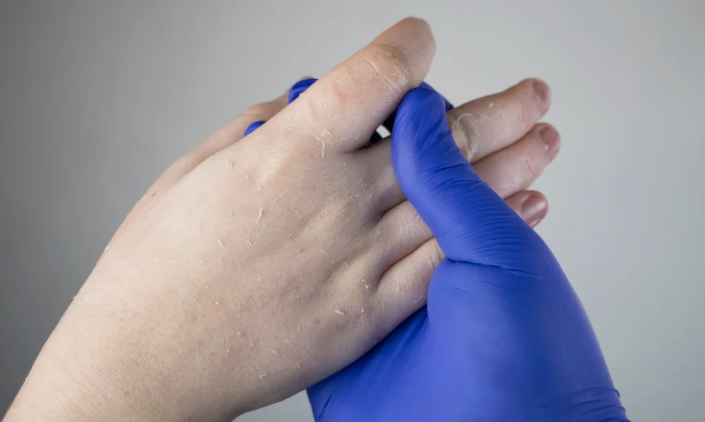 Bioresonance Therapy And Mycosis