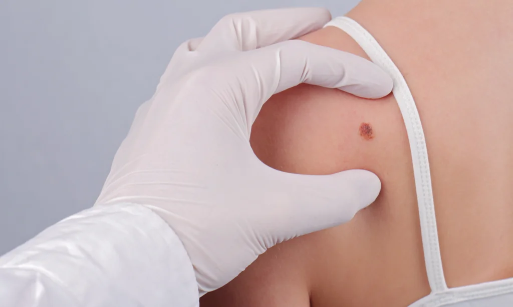 Bioresonance Therapy And Melanoma