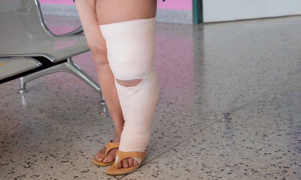 Bioresonance Therapy And Lymphedema: A Good Alternative Treatment Option?