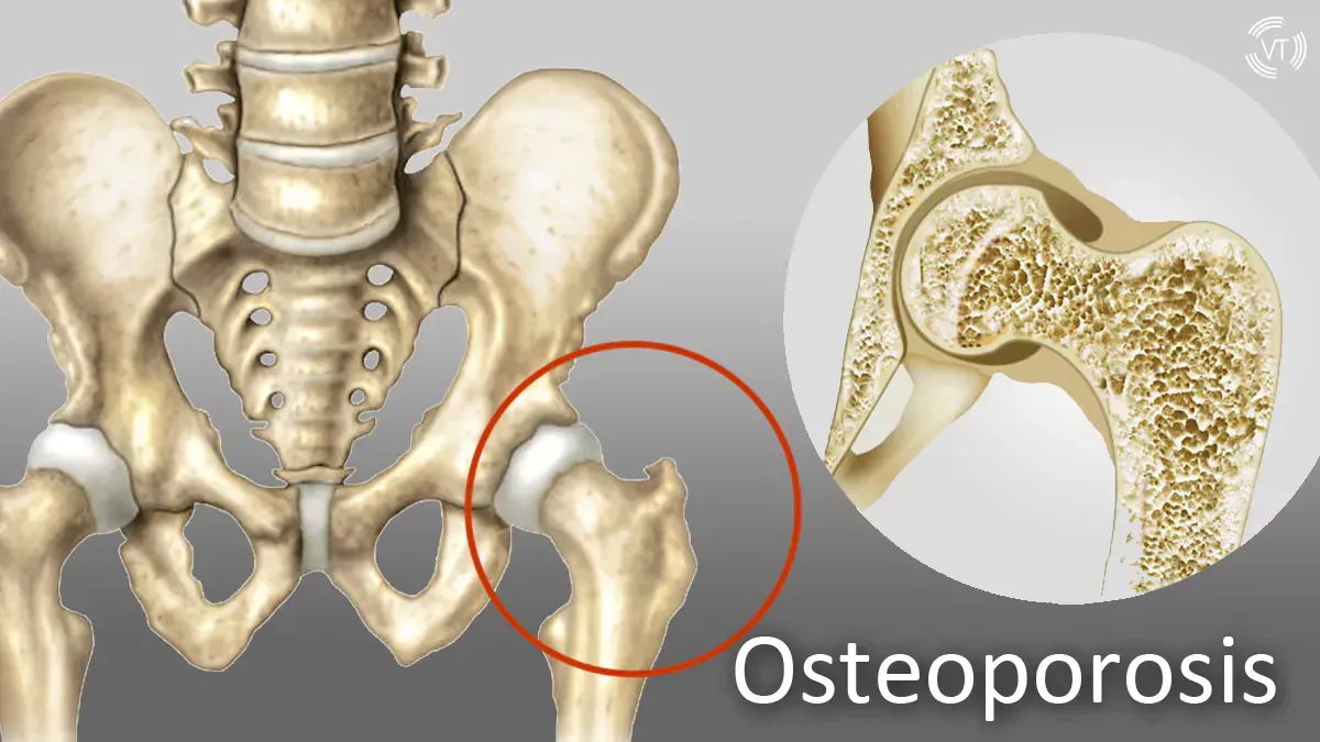 Osteoporosis