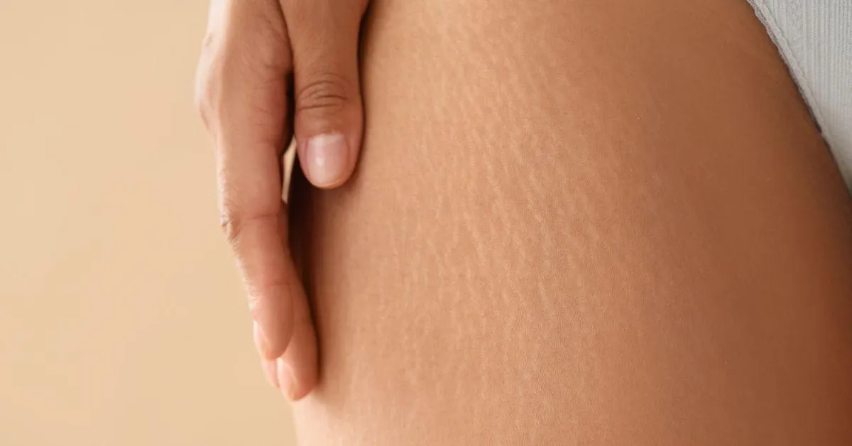 Smooth, Even Skin: How Aerolase Helps Fade Scars & Stretch Marks Naturally